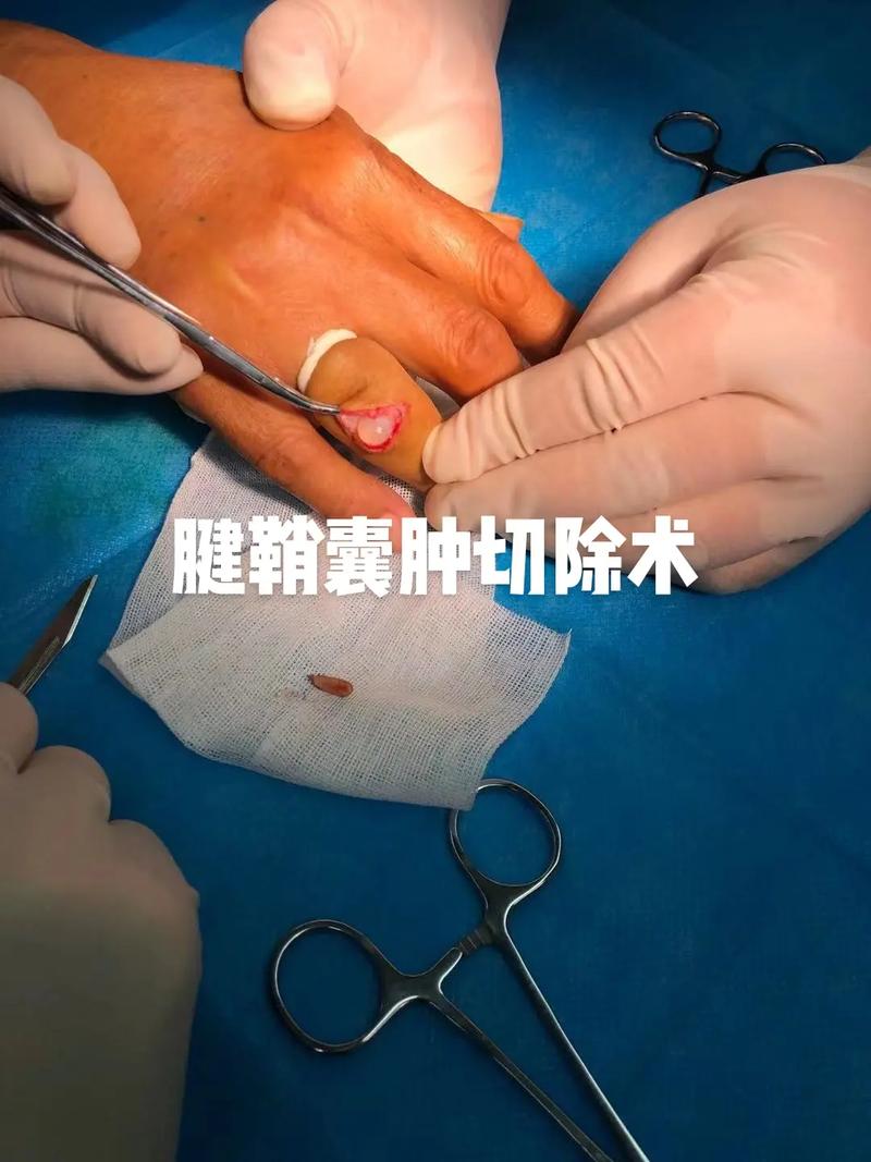 腱鞘囊肿的治疗方法有哪些男生腱鞘囊肿做腱鞘囊肿切除手术大概要多少钱 圆脸