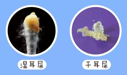 幼童耳垢堵塞怎么办5年未清理耳屎患瘤怎么办耳屎是哪来的？经常掏耳朵有坏处吗