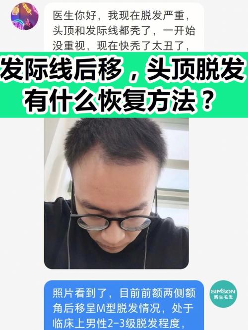 发际线上移怎么补救发际线上移是脱发吗怎么治疗随着年龄增长发际线会渐渐上移吗 简单